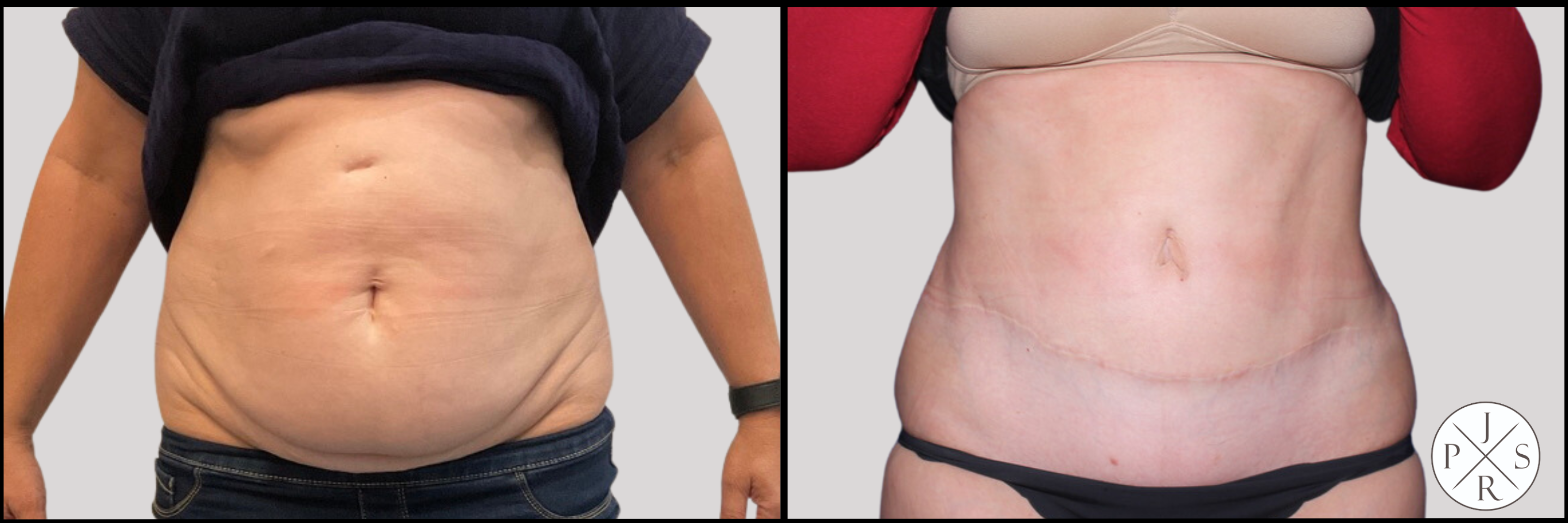 Abdominoplasty Before & After Image